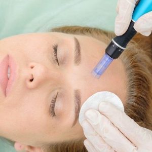 microneedling for acne-cosmetic treatments microneedling profile image