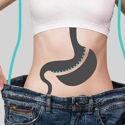 sleeve any bypass-cosmetic surgery sleeve and bypass surgery profile image